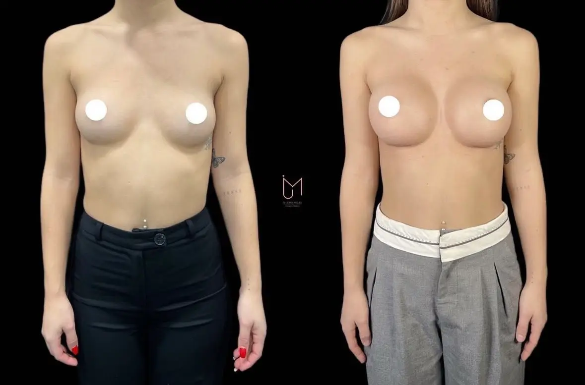 3 meses antes y despues aumento de de pecho dr jordi miquel
