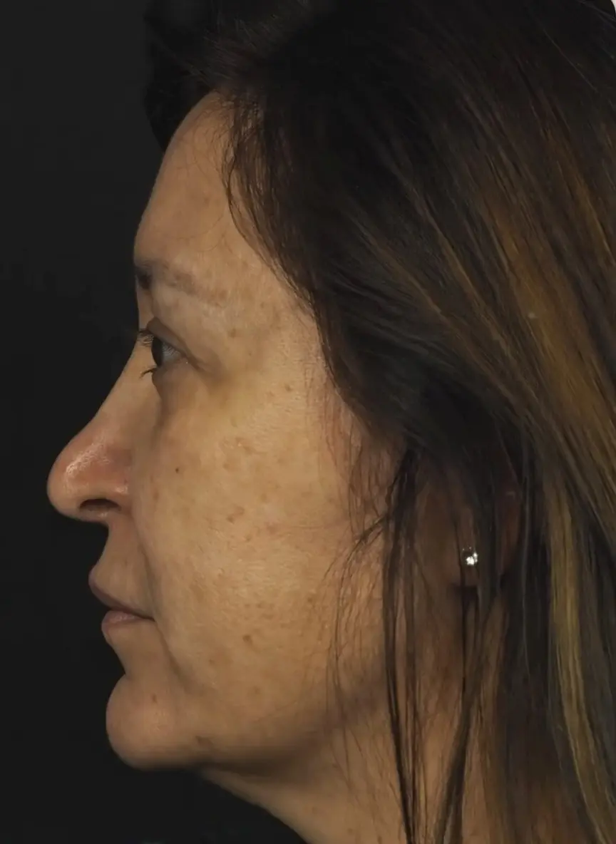 Antes rinoplastia secundaria en Barcelona Dr Jordi Miquel