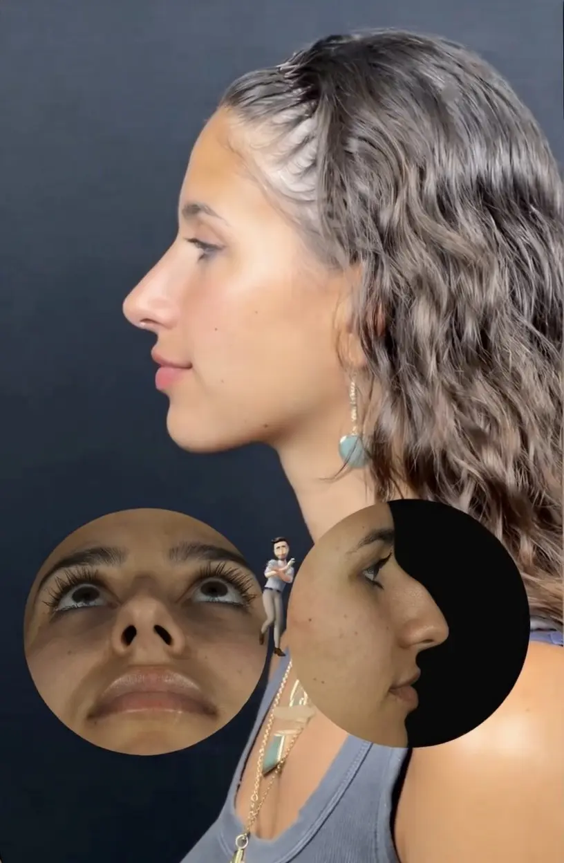 Antes y despues Rinoplastia etnica en Barcelona Dr Jordi Miquel 1