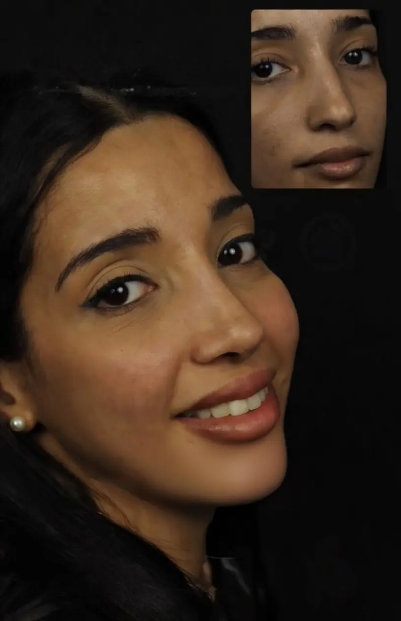 Antes y despues Rinoplastia etnica en Barcelona Dr Jordi Miquel