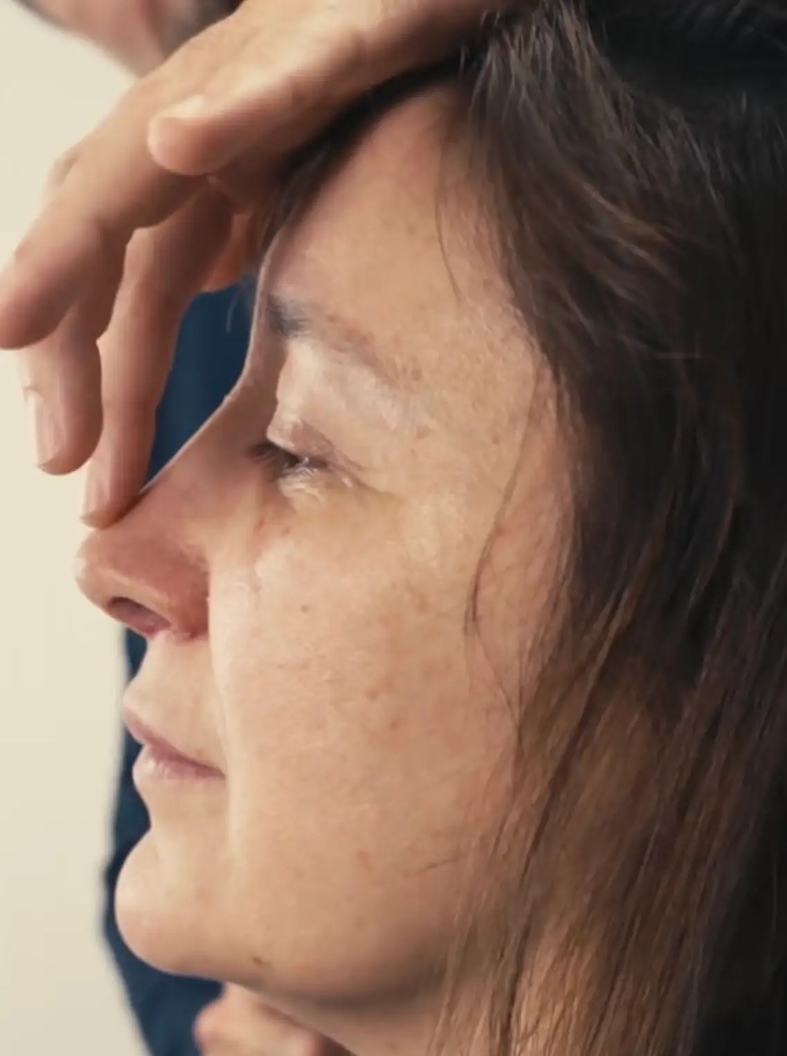 Despues rinoplastia secundaria en Barcelona Dr Jordi Miquel