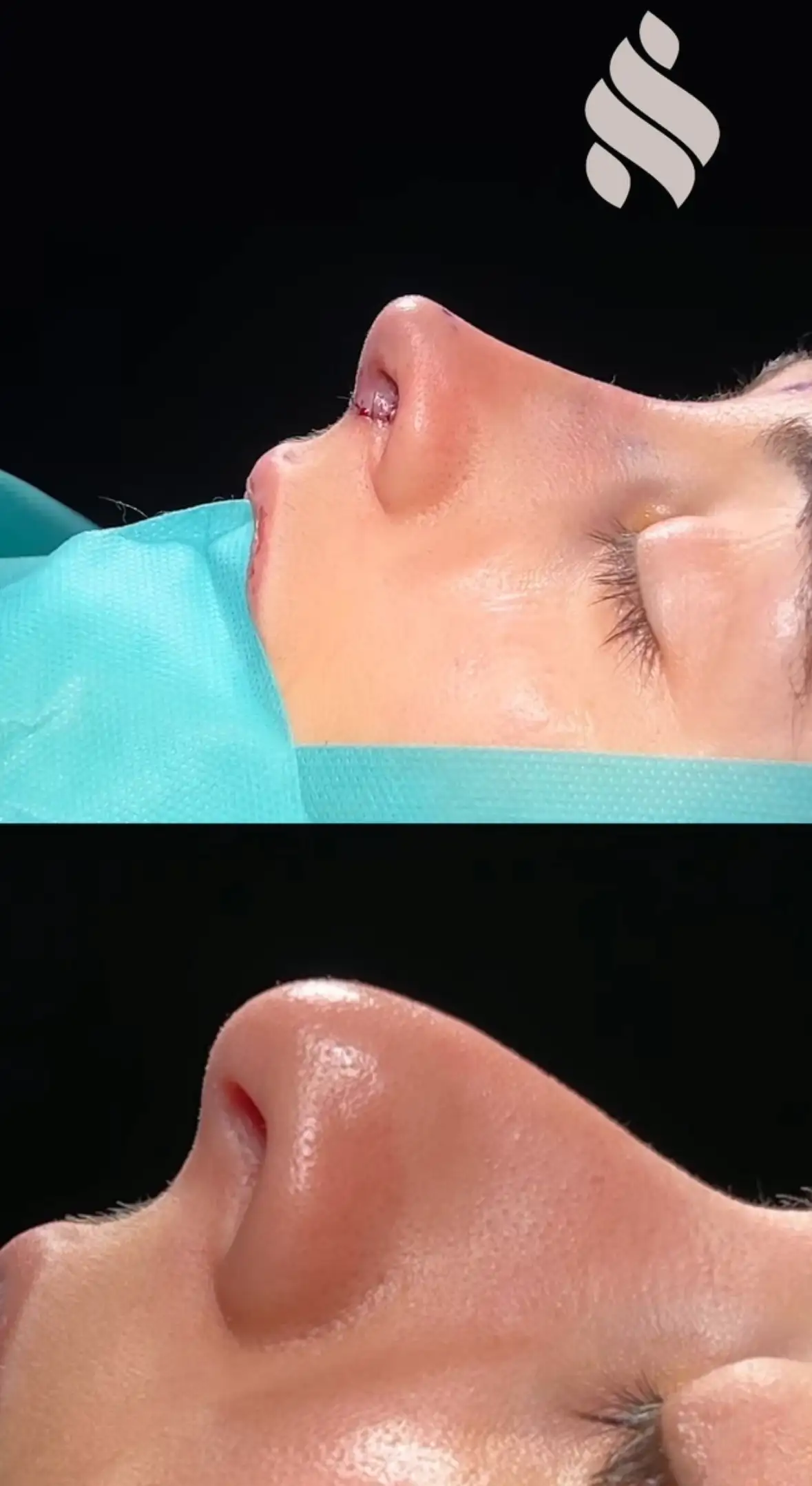 Nariz aguilena rinoplastia ultrasnica Barcelona Dr Jordi Miquel