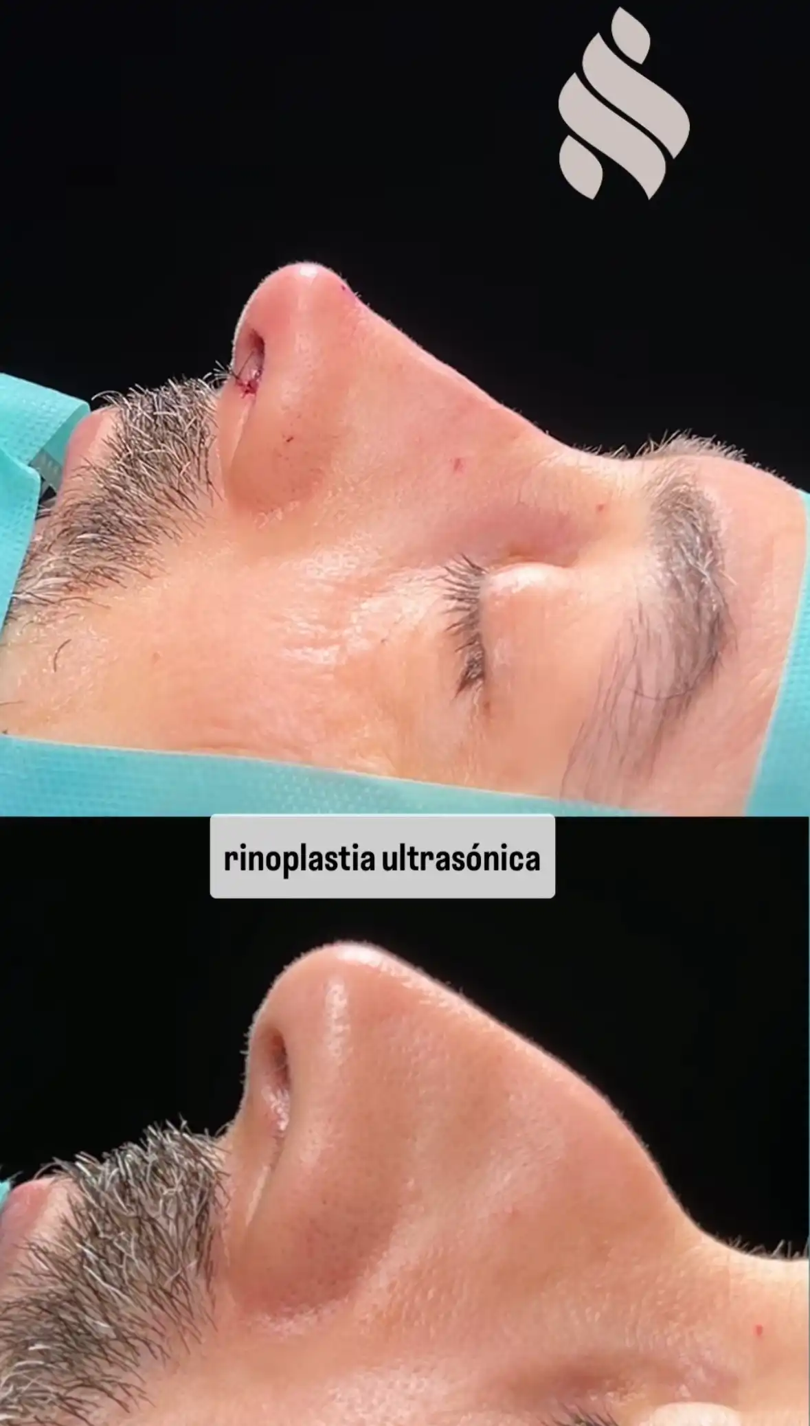 Nariz aguilena rinoplastia ultrasnica Barcelona en hombre