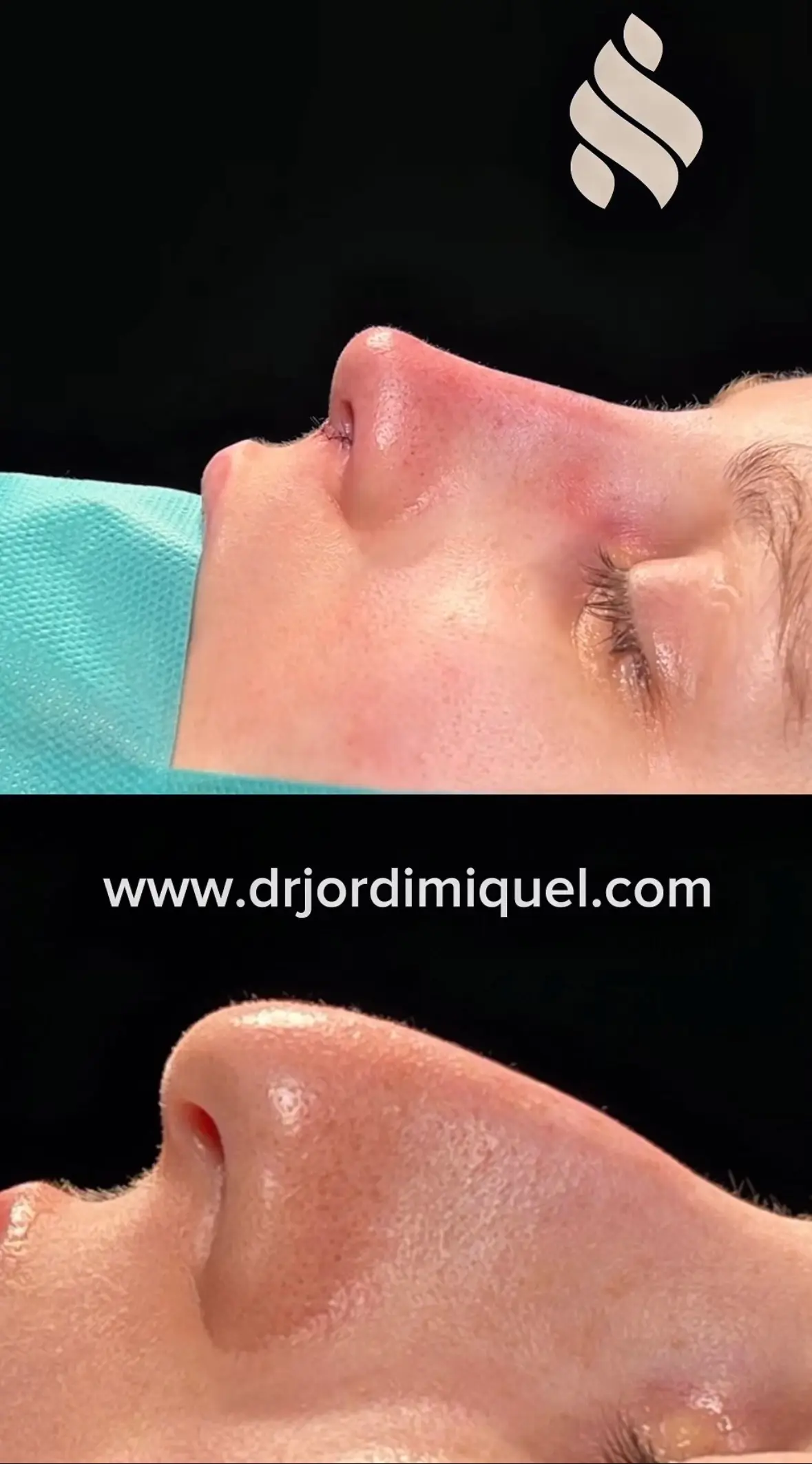 Nariz caida rinoplastia ultrasonica en barcelona 1