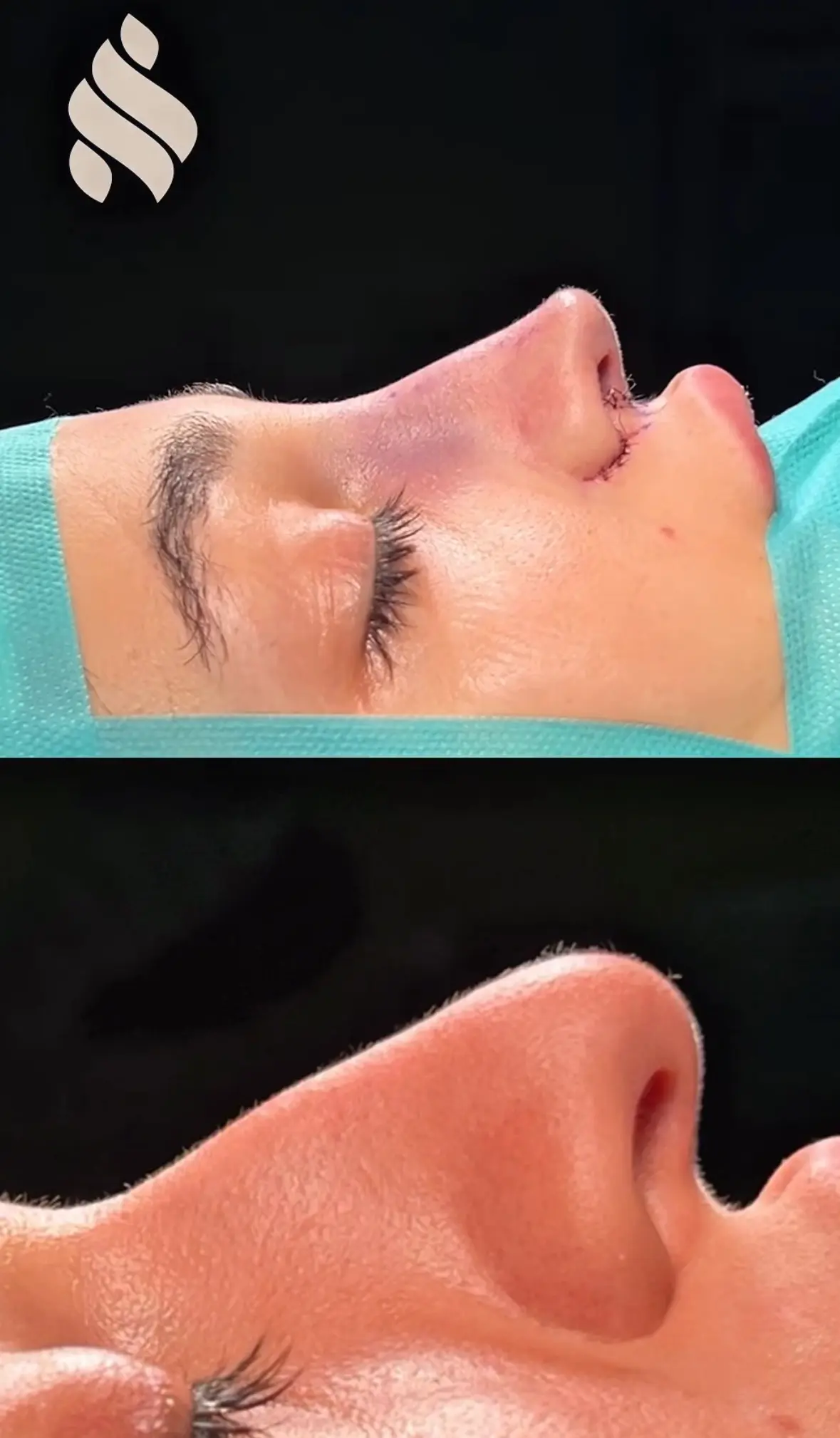 Nariz caida rinoplastia ultrasonica en barcelona dr jordi miquel 1