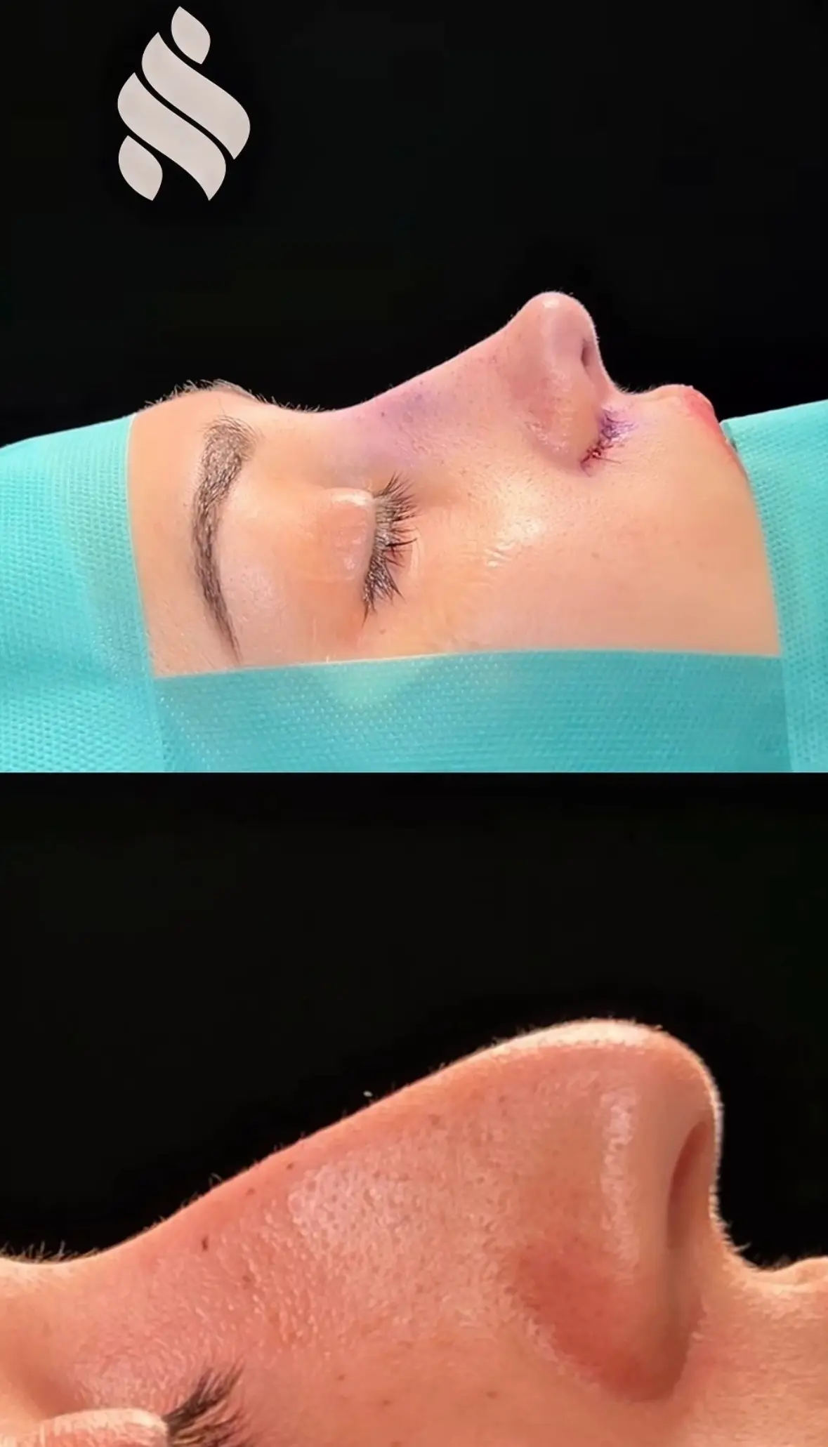 Nariz caida rinoplastia ultrasonica en barcelona dr jordi miquel