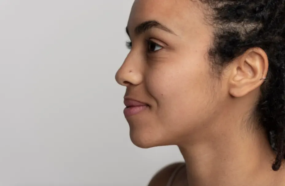 Nariz etnica en Barcelona correccion con Dr Jordi Miquel