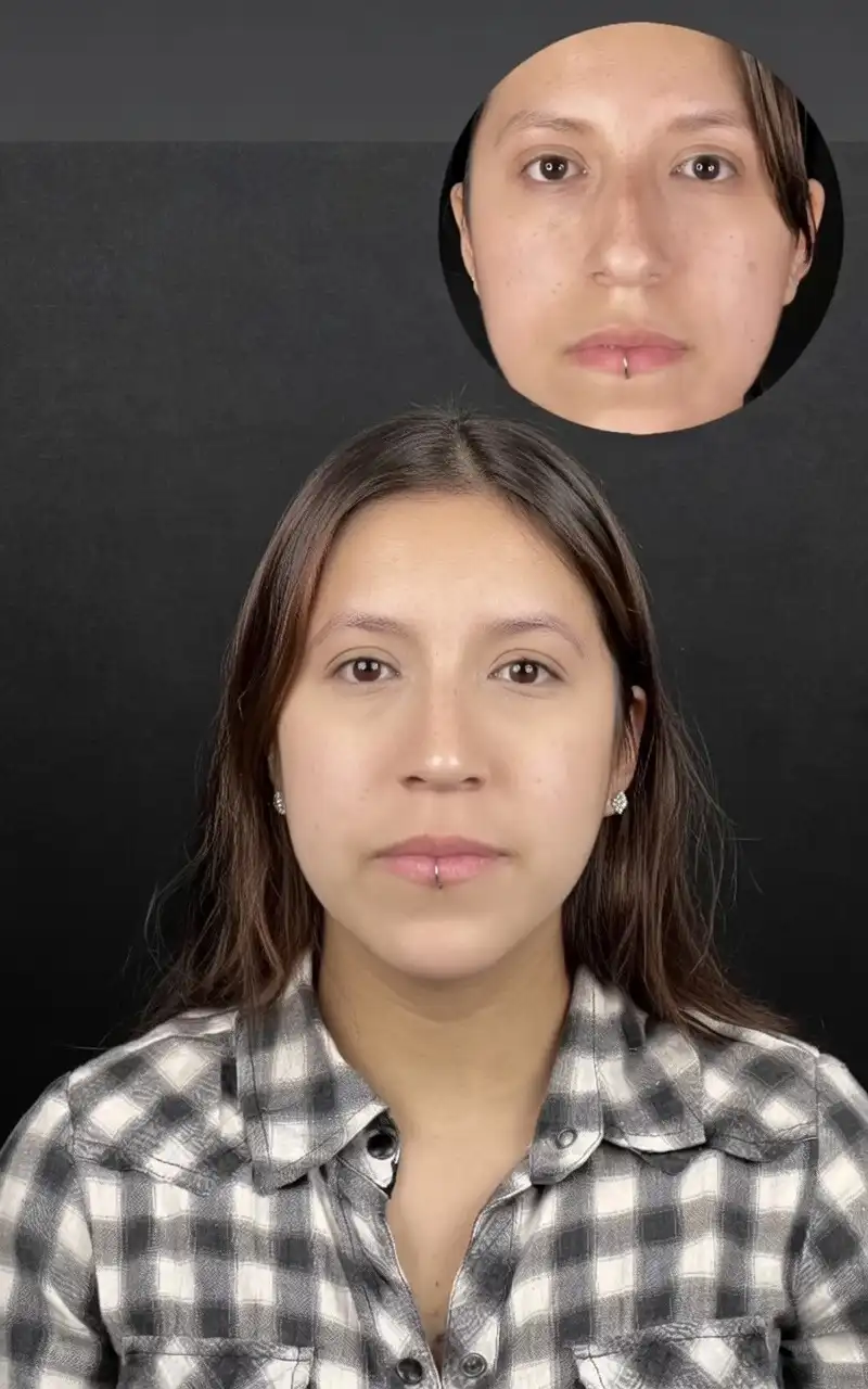 Rinoplastia etnica en Barcelona Dr Jordi Miquel 1