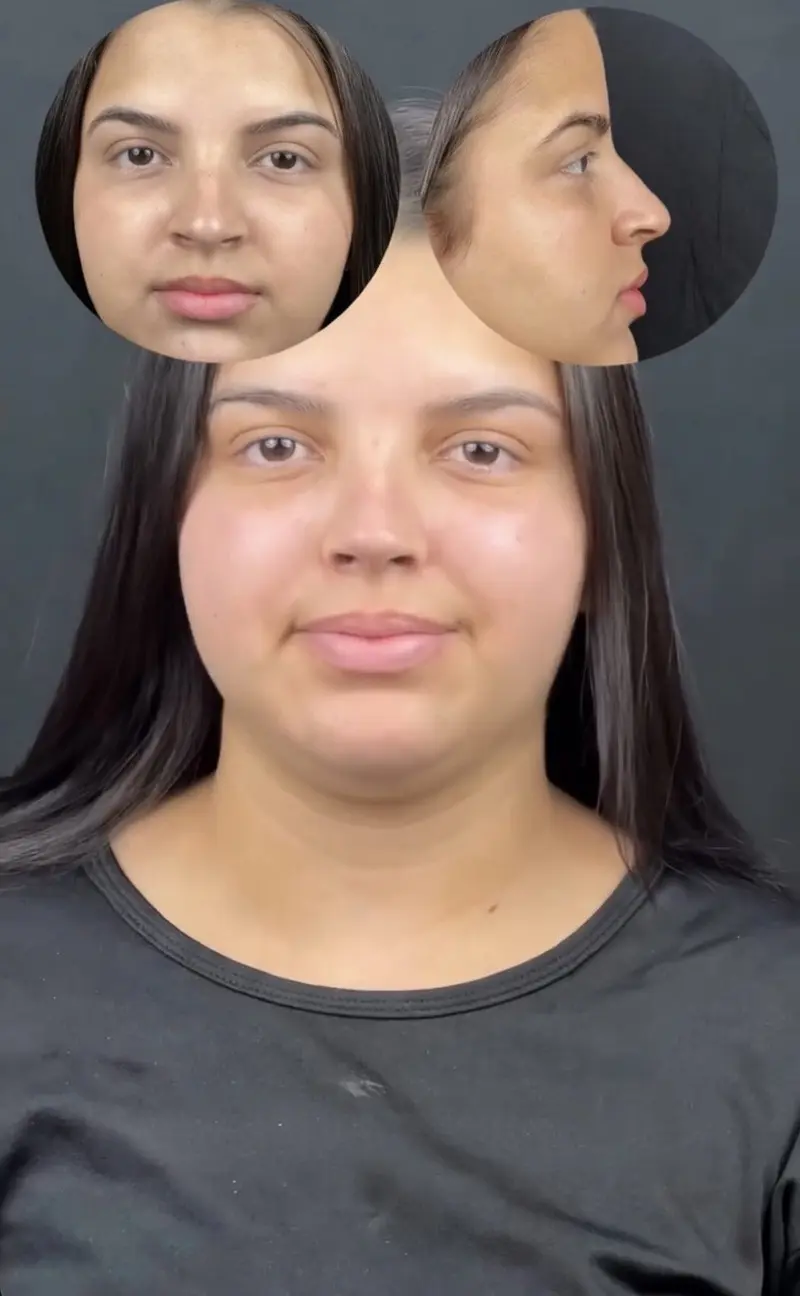 Rinoplastia etnica en Barcelona Dr Jordi Miquel