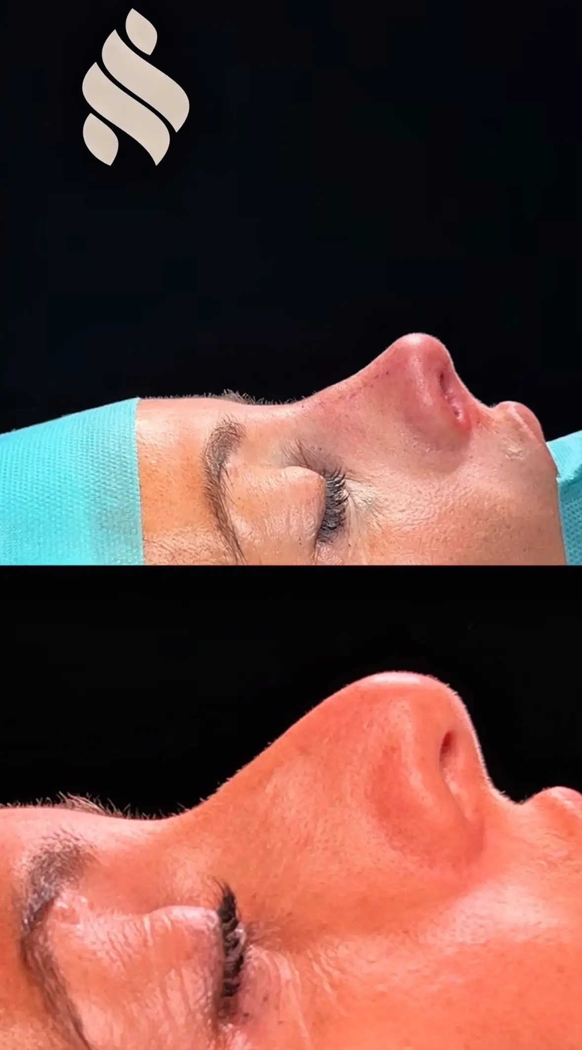 antes y despues nariz bulbosa barcelona dr jordi miquel