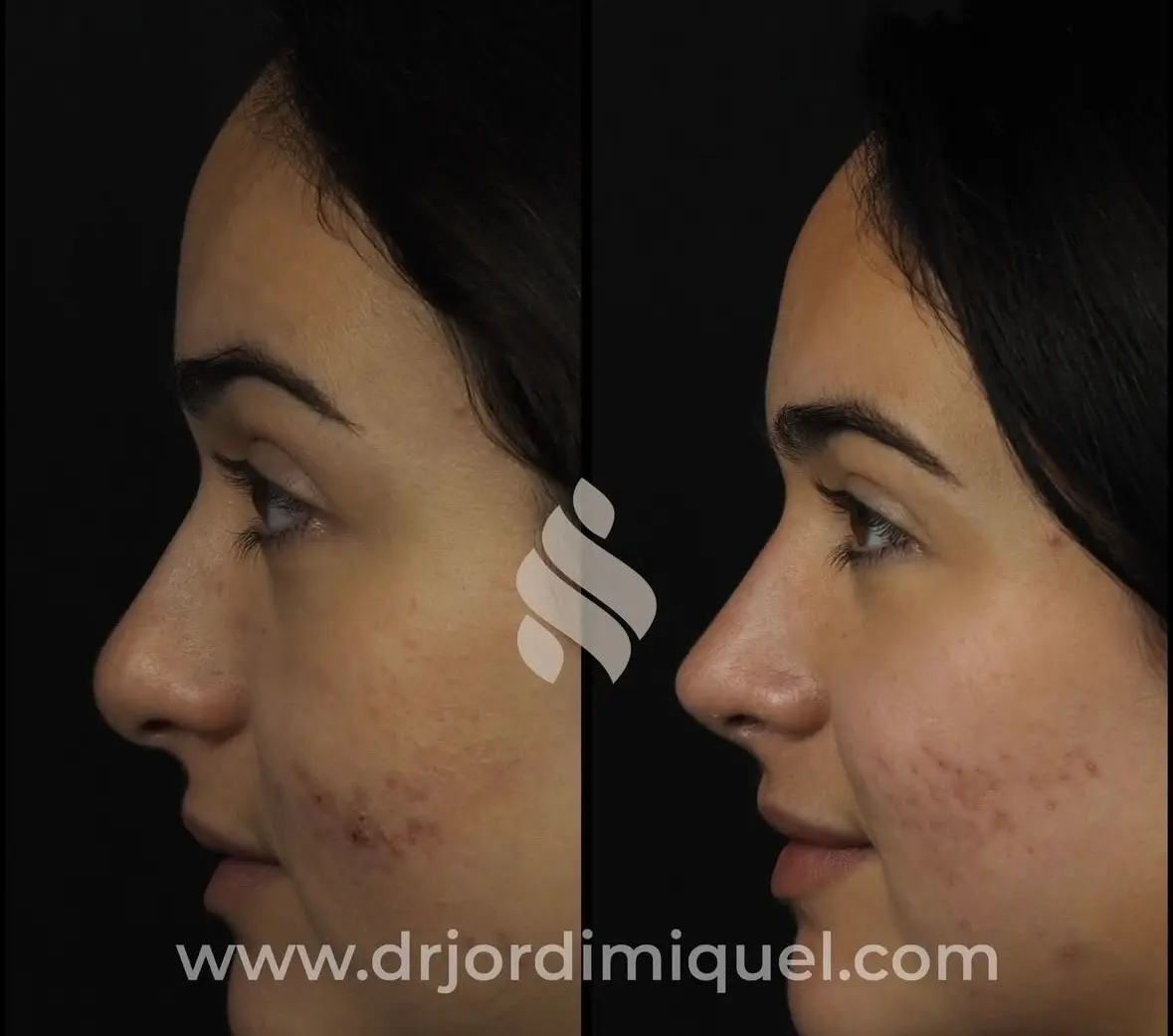 antes y despues nariz bulbosa barcelona