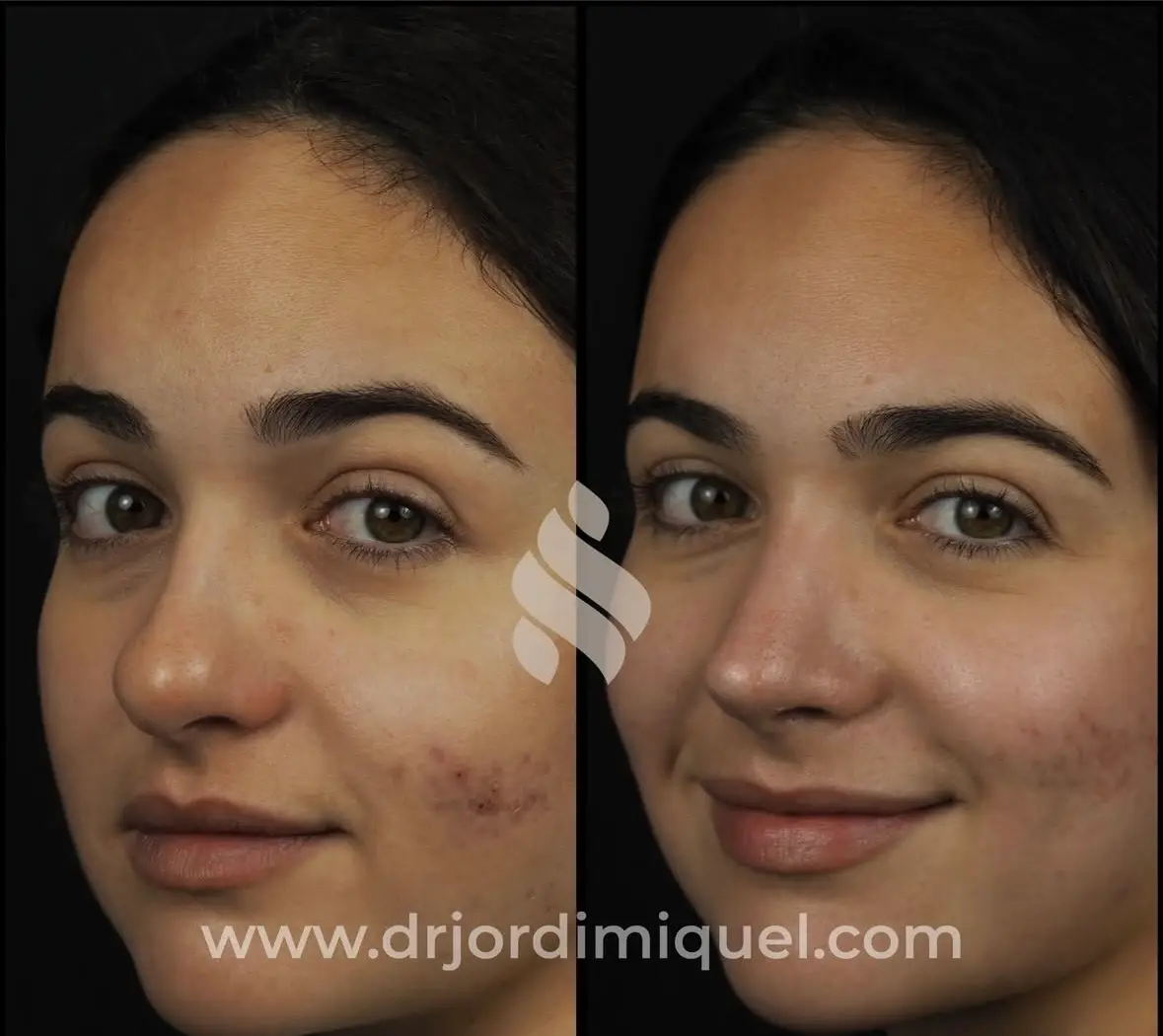 antes y despues nariz bulbosa