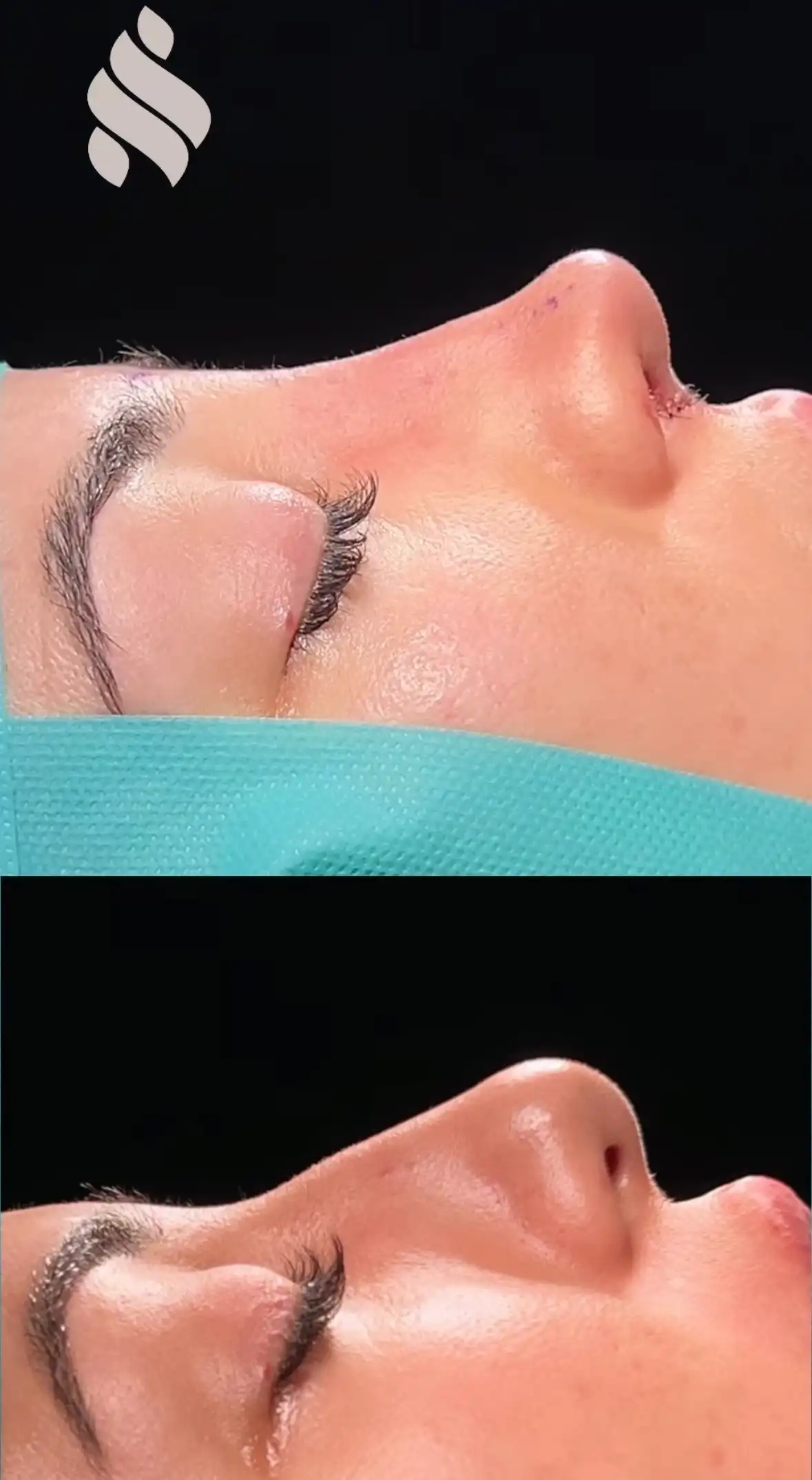 nariz bulbosa barcelona