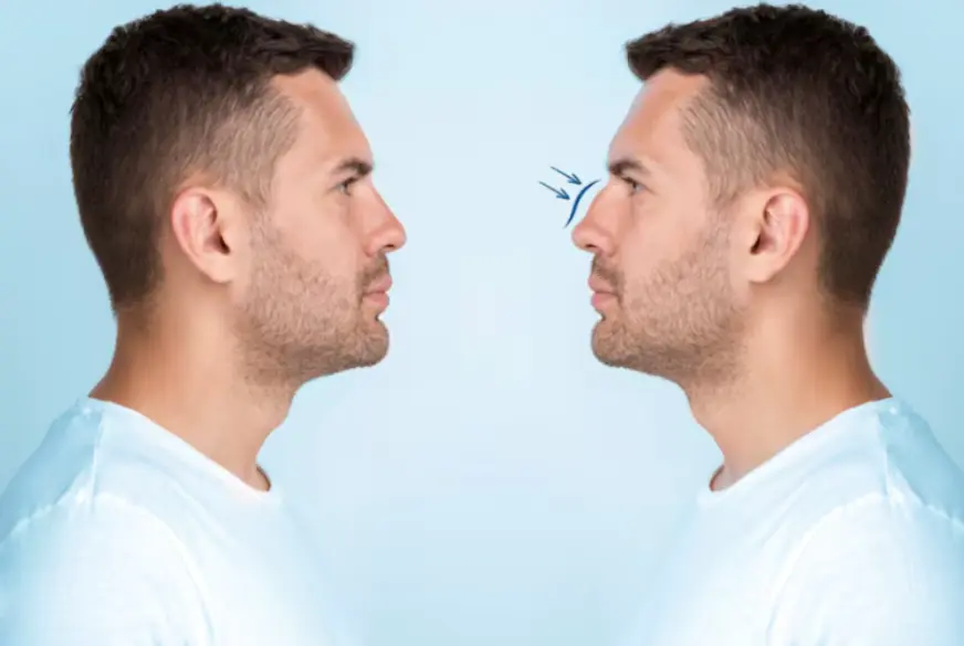 rinoplastia en hombres