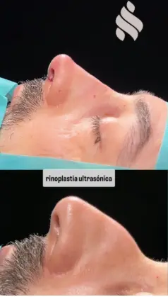 Simulador rinoplastia dr jordi miquel2