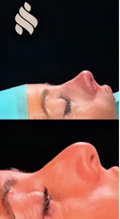 Simulador rinoplastia dr jordi miquel3