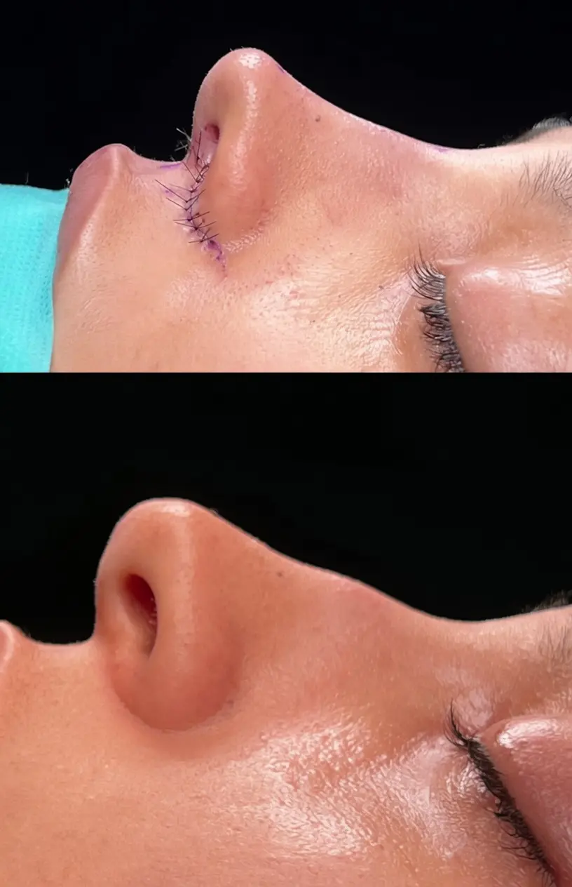 nariz chata rinoplastia ultrasonica en barcelona dr jordi miquel