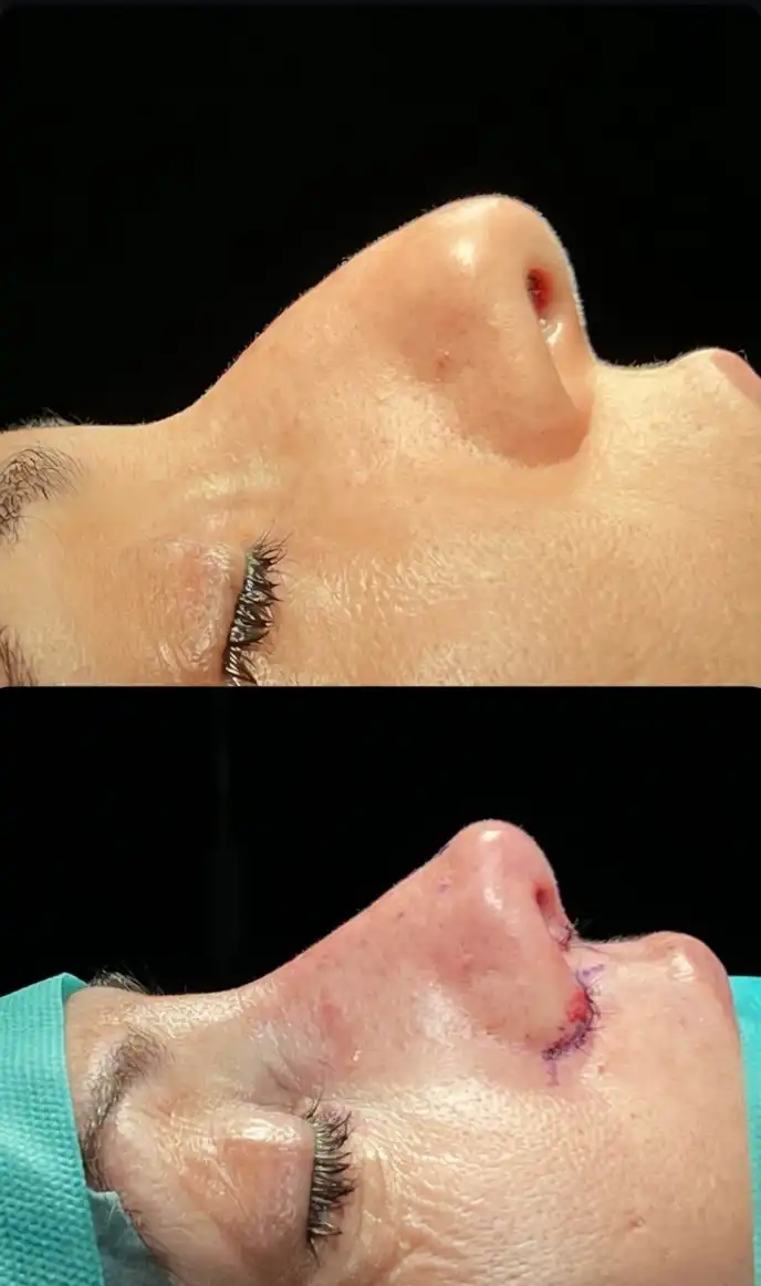 nariz chata rinoplastia ultrasonica en barcelona dr jordi miquel7