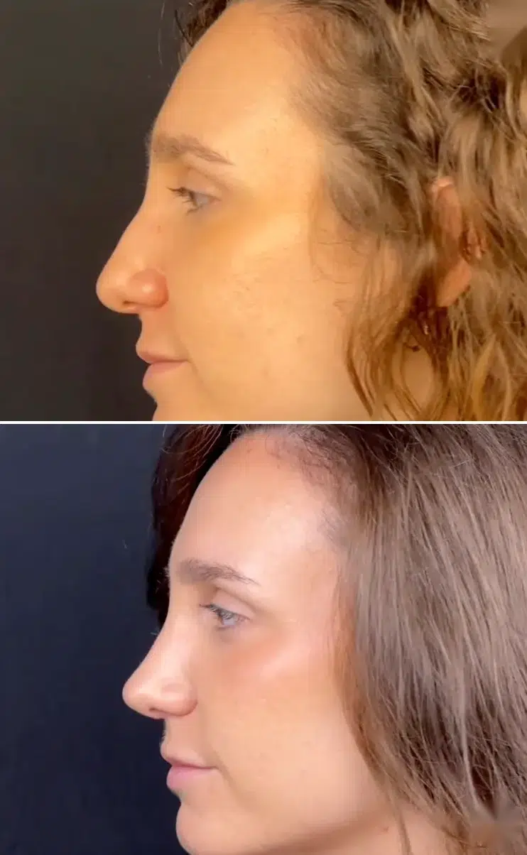 nariz respingada rinoplastia barcelona antes despues