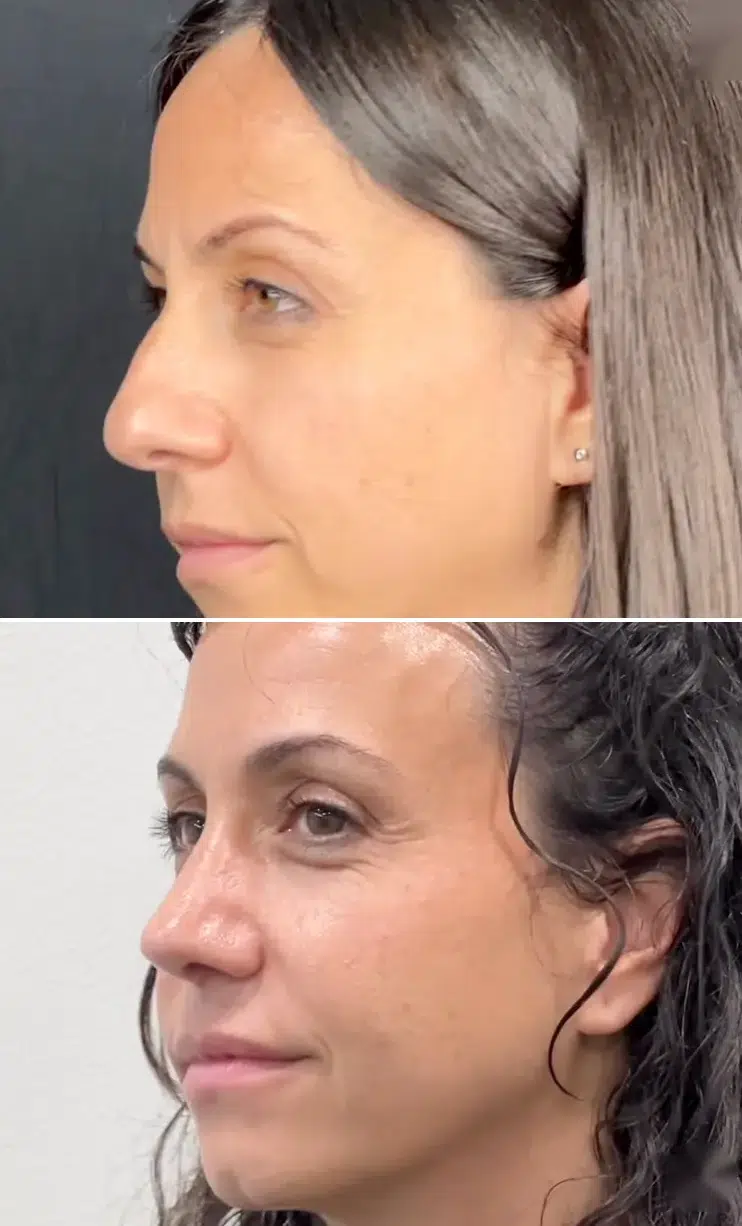 rinoplastia preservacion antes despues